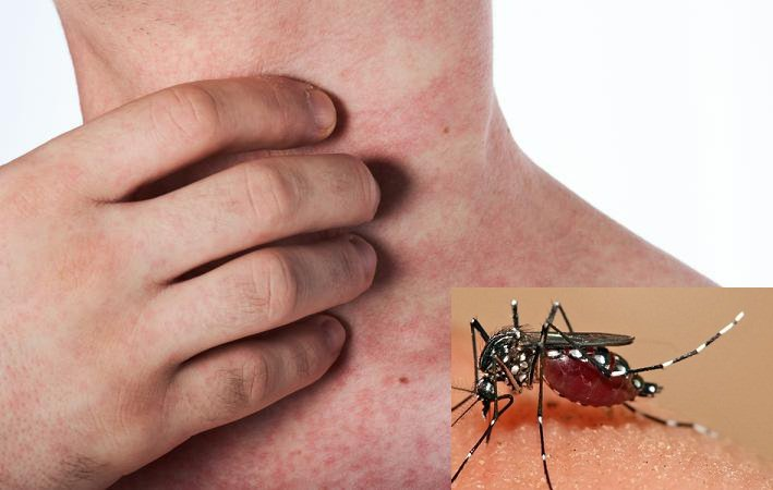 Bệnh do muỗi mang virus chích vào cơ thể gây ra